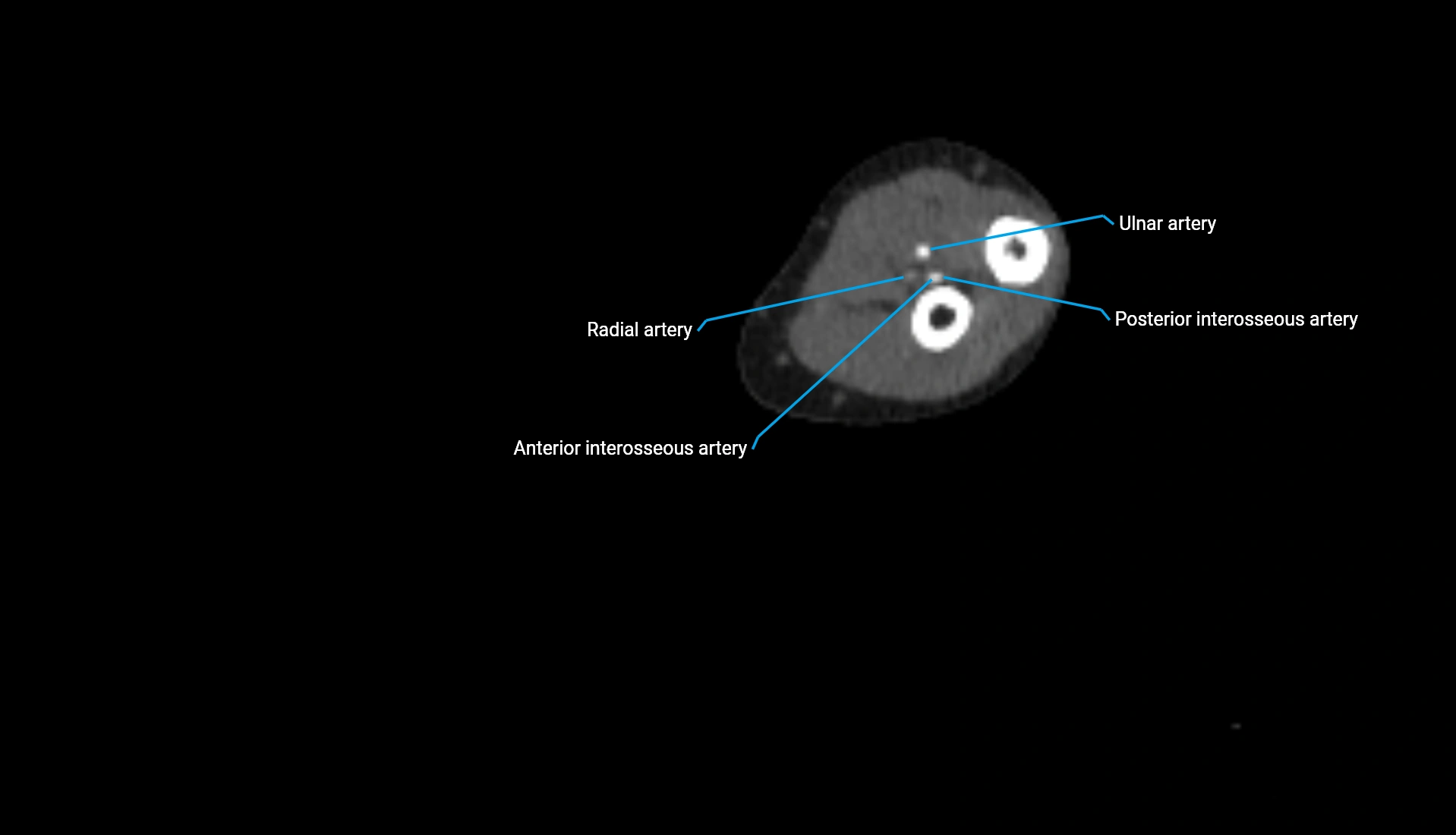 CTA upper limb axial cross sectional anatomy labelled image 164 (2).webp